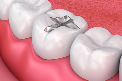 The image shows a close-up view of a human dental implant integrated into a tooth with an artificial crown, set against a background that appears to be a medical or dental office environment.