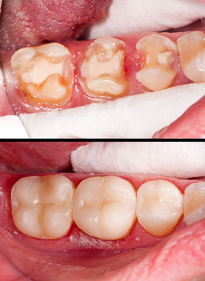 The image displays a close-up view of a person s mouth with a focus on their teeth, which are missing and show signs of decay and gum disease.