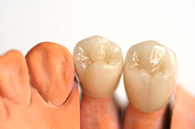 The image shows two rows of artificial teeth placed side by side against a white background, with the upper row appearing more natural due to a glossy finish and the lower row having a matte finish.