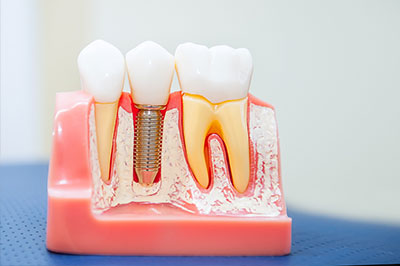 The image shows a model of a human mouth with artificial teeth and gums, featuring several dental implants and screws.