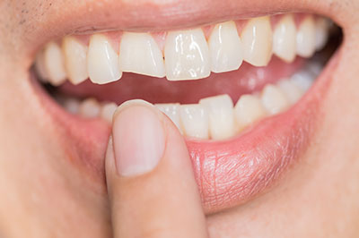 The image shows a close-up view of a person s mouth with teeth, holding a finger over their lips, against a blurred background.