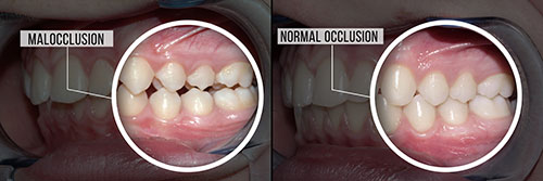 The image shows two photographs side by side of a dental procedure with a focus on oral health, emphasizing before and after results, likely for educational or promotional purposes.