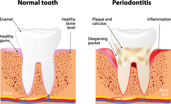 The image presents a detailed scientific illustration comparing normal tooth structure with periodontitis-affected teeth, highlighting bone loss around the teeth and gums.