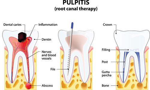 The image depicts a detailed illustration of the anatomy of a human tooth, with labels indicating dental structures such as the enamel, dentin, pulp chamber, and root canal therapy, accompanied by annotations explaining certain aspects of the tooth s structure.