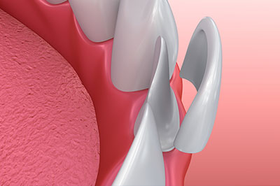 The image shows a close-up view of a dental implant fixture with multiple spikes or points on its surface, placed within a pink oral cavity model with visible teeth roots.