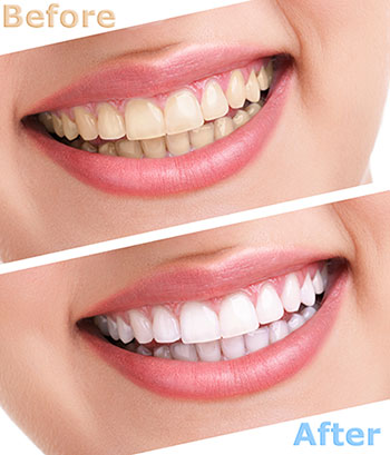 The image shows a comparison of dental whitening results before and after treatment, featuring a smiling woman with two photos side by side highlighting the transformation from stained teeth to cleaner ones.